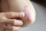 Skin disorders related, Skin disorders articles, five common skin disorders and their symptoms, Immune system