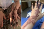 henna, black henna tattoo burns, henna tattoo cause aussie woman to almost lose her hand, Phenyl