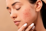 skin care products, pimples, 10 ways to get rid of pimples at home, Skincare