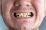 Nicotine stains irreversible, Nicotine stains bad, are nicotine stains on your teeth irreversible, Smile